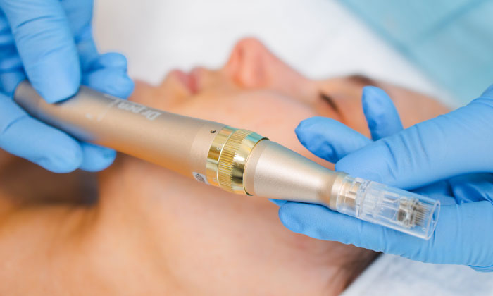 Dermapen sau mezoterapia fractionala in Moldova