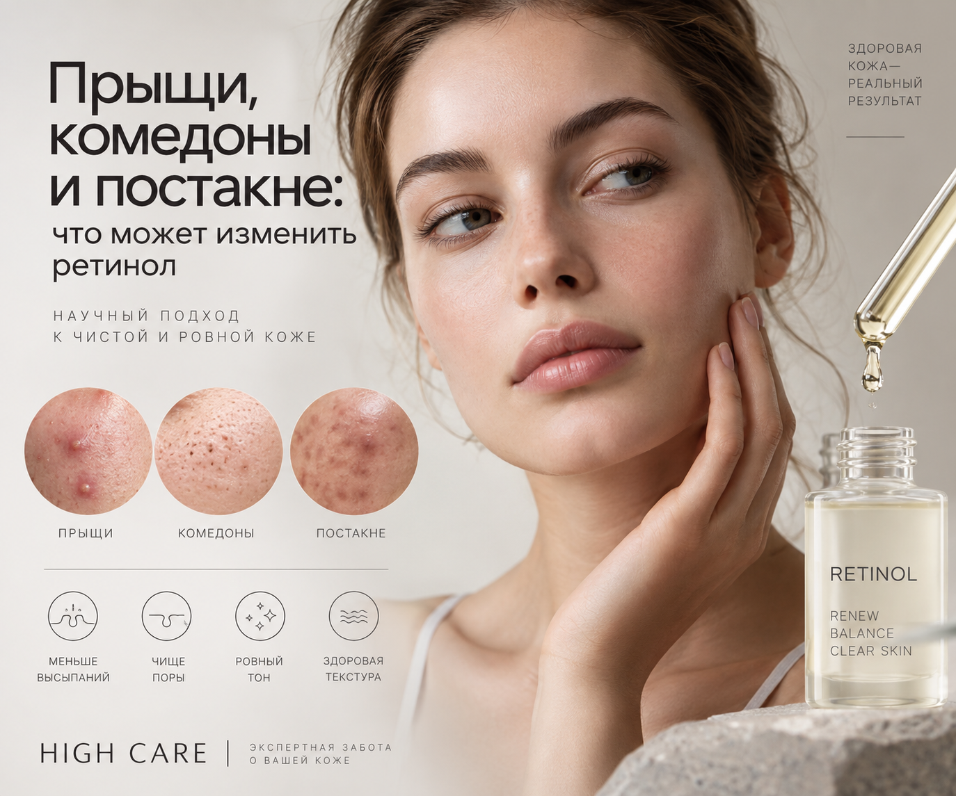Прыщи, комедоны и постакне: как ретиноиды меняют проблемную кож